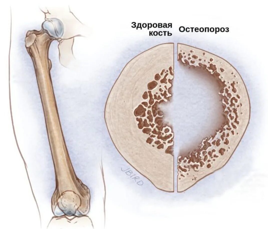 Лечение костных заболеваний. Болезнь хрупких костей. Остеопороз кость.