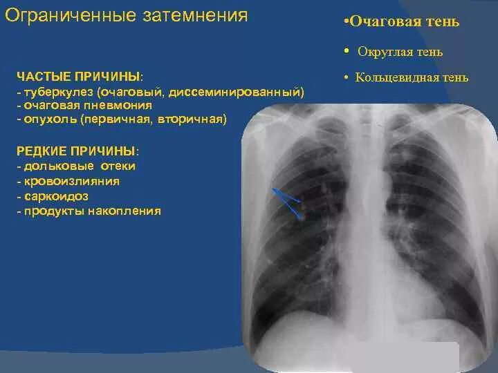 Округлое затемнение. Очаговая тень рентген. Очаговая тень туберкулез. Очаговые тени в легких на рентгене.