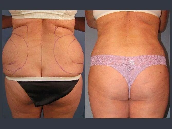 Lipolaser - laser lipolysis - Lux Medicus