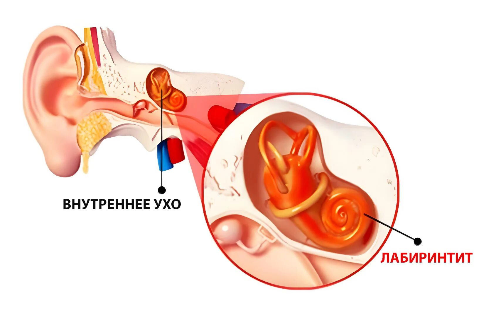 Внутреннее ухо лечение и симптомы. Воспаление внутреннего уха лабиринтит. Воспаление среднего уха (лабиринтит);. Воспаление среднего уха лабиринтит симптомы. Воспалительные заболевания внутреннего уха (лабиринтиты)..