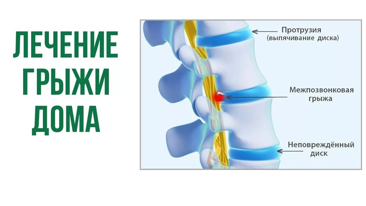 Сильные боли грыжа позвоночника. Грыжа позвоночника. Грыжа позвоночника поясничного отдела. Межпозвонковая грыжа в пояснице.