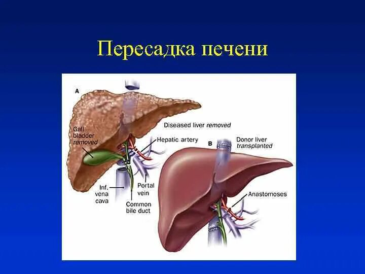 Трансплантация печени. Трансплантация части печени. После пересадки печени