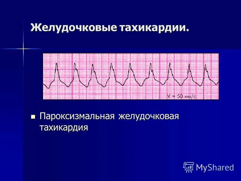 Желудочковая тахикардия на экг. Пароксизмальная желудочковая тахикардия на ЭКГ. Пароксизм желудочковой тахикардии ЭКГ. ЭКГ при желудочковой пароксизмальной тахикардии. ЭКГ желудочковая тахикардия ЭКГ.