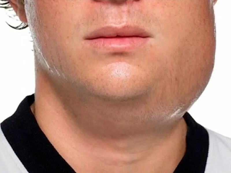 Свинка у взрослых мужчин. Паротит околоушной у детей. Послеоперационный паротит. Свинка у взрослых мужчин. Эпидемиологический паротит свинка.