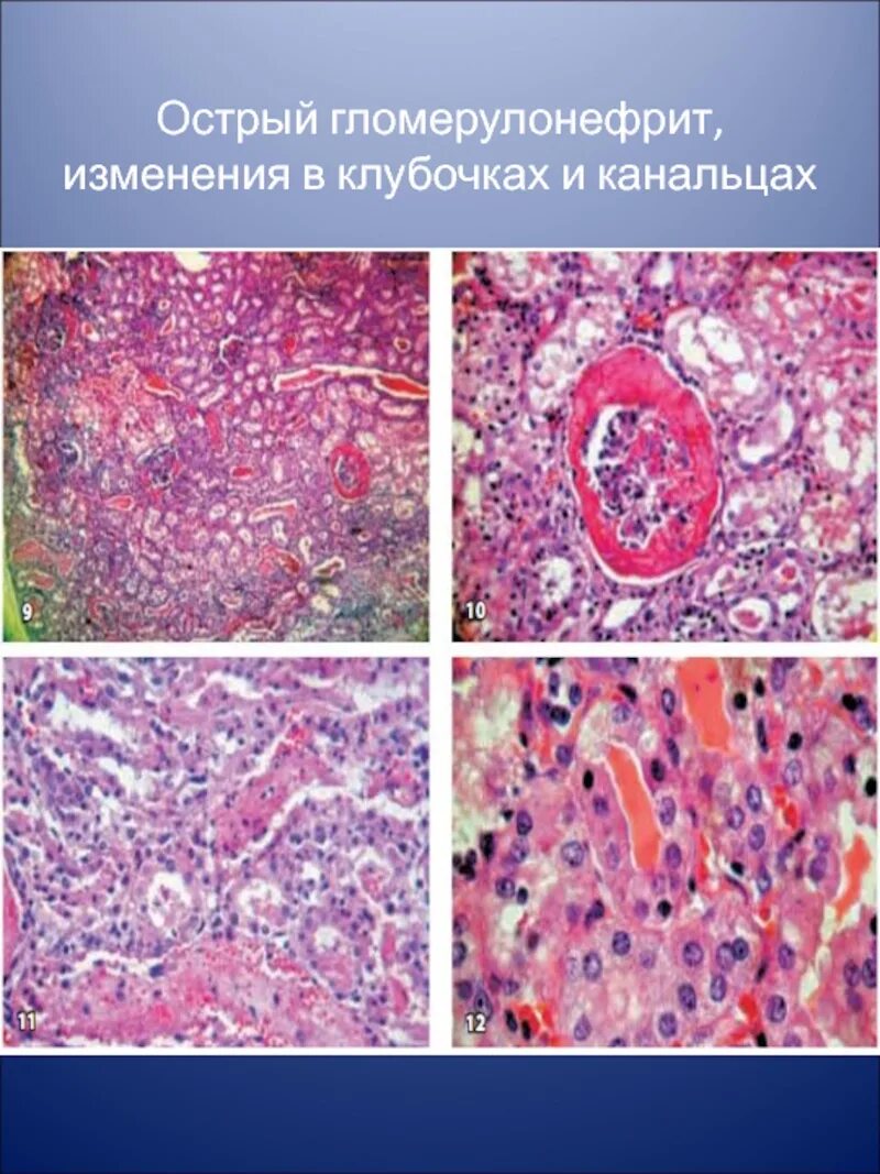 Гломерулонефрит эритроциты. Диффузный интракапиллярный гломерулонефрит. поражение клубочков гломерулонефрит. мезангиопролиферативный гломерулонефрит этиология. бактериальный гломерулонефрит.