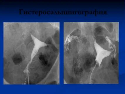 Гистеросальпингография маточных труб