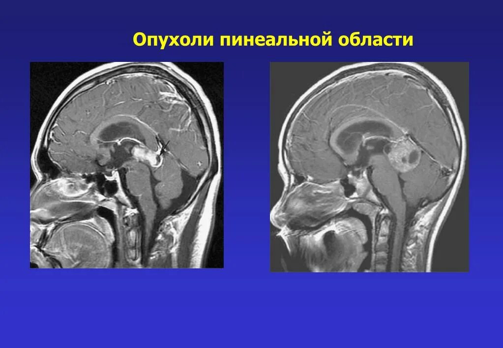 Герминома. Пинеальная область опухоль. Объемное образование пинеальной области. Пинеальной области головного мозга.