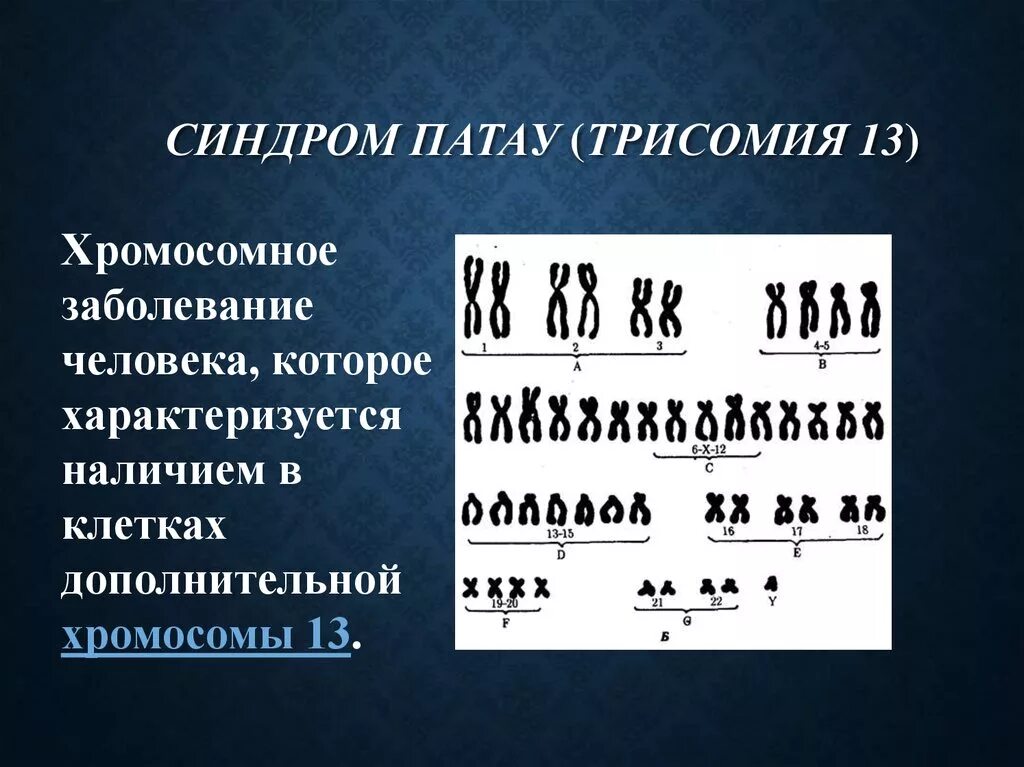 4 хромосома заболевание. Синдром Патау трисомия по 13 хромосоме. Хромосомные аномалии (синдром Патау, трисомия 13. Синдром Патау трисомия хромосомы 13. Хромосомные болезни синдром Патау.