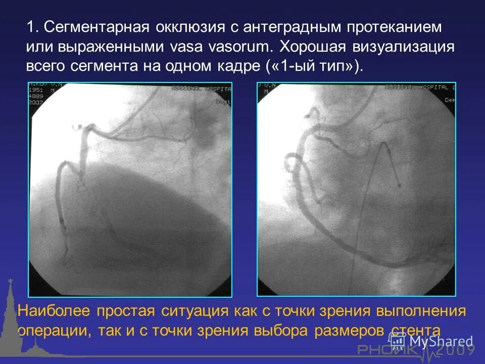 Точки определения пульсации на артериях нижних конечностей. Окклюзия передней бедренной артерии. Окклюзия бедренного сегмента. Окклюзия бедренно-подколенного сегмента сегмента. Окклюзия артерий нижних.