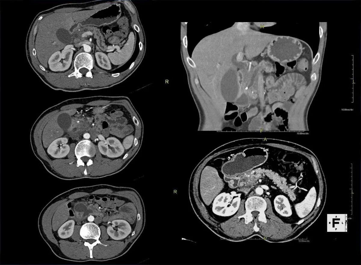Томограмма брюшной полости кт. Мрт снимки поджелудочной железы. Конкременты поджелудочной железы кт. Псевдотуморозный панкреатит на кт.