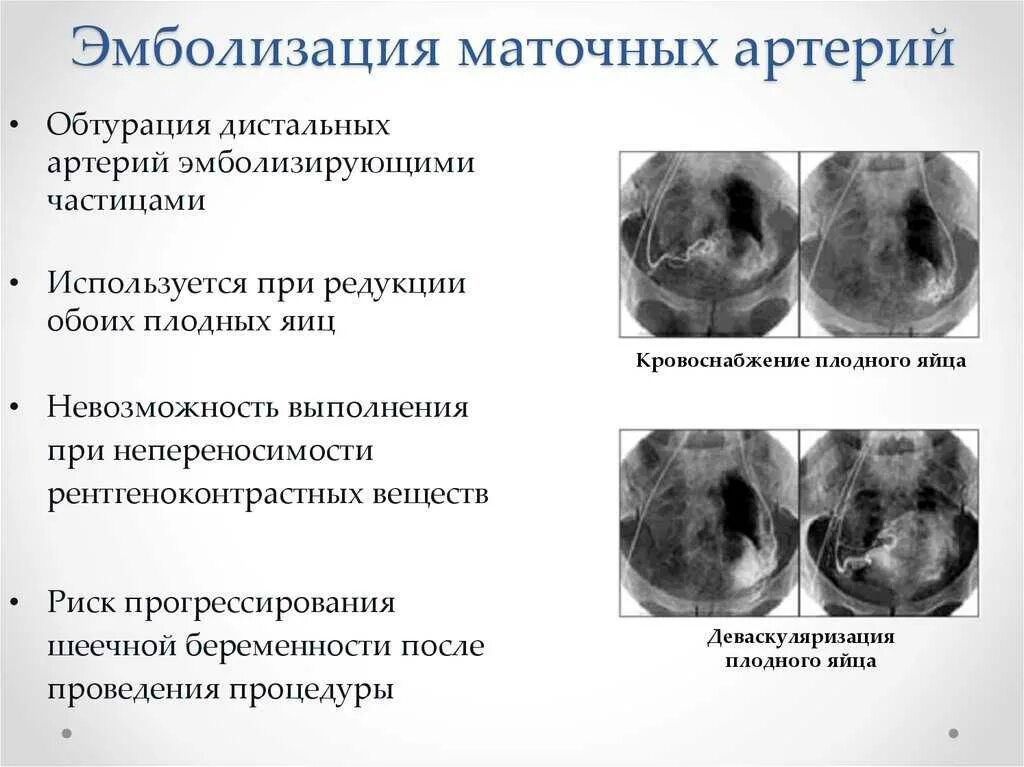 Эма миомы матки. Эмболизация маточных артерий. эмболизации маточных артерий. эмболизация маточных артерий при шеечной беременности. эмболизации маточных артерий (эма)..