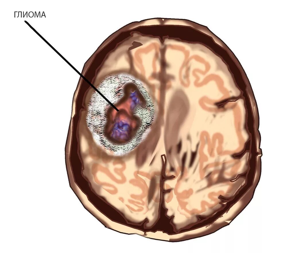 Злокачественная глиома головного мозга. Опухоль головного мозга глиома. Глиальная опухоль головного мозга.