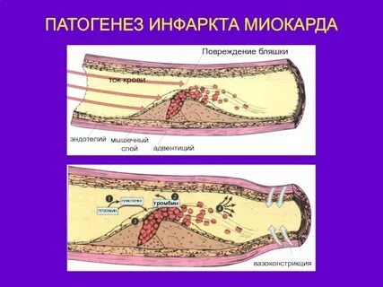 3 тип острого инфаркта миокарда это