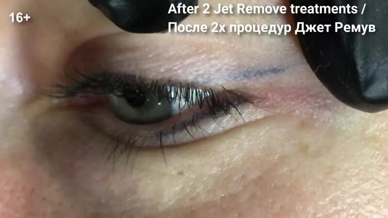 Ремувер для удаления татуажа. Ремувер для снятия татуажа бровей. Удаление ремувером видео. Удаление ремувером видео. Удаление стрелок ремувером.