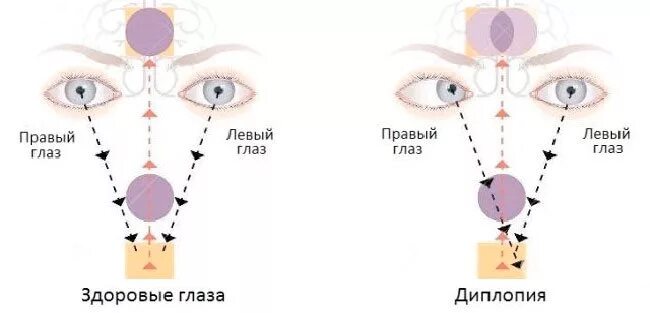 Нарушение зрения диплопия. Бинокулярная диплопия причины. Вертикальная диплопия причины. Двоение в глазах диплопия. Двоение в одном глазу