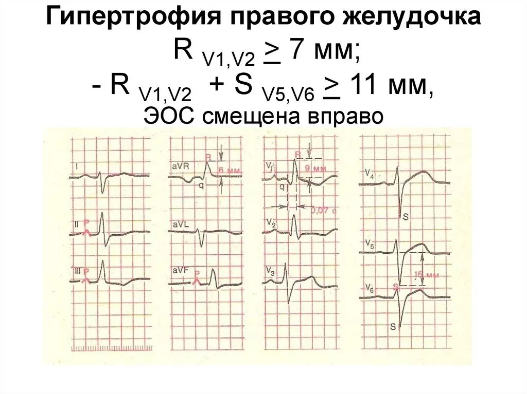 Глж на экг что это значит. ЭКГ критерии гипертрофии правого желудочка. Критерии гипертрофии правого и левого желудочка на ЭКГ. ЭКГ при гипертрофии пж. Признаки гипертрофии правого желудочка на ЭКГ.