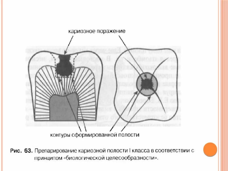 Принципы препарирования полостей. Основные элементы кариозной полости. этапы препарирования кариозных полостей. основные принципы и этапы препарирования кариозных полостей.. этап вскрытия кариозной полости.