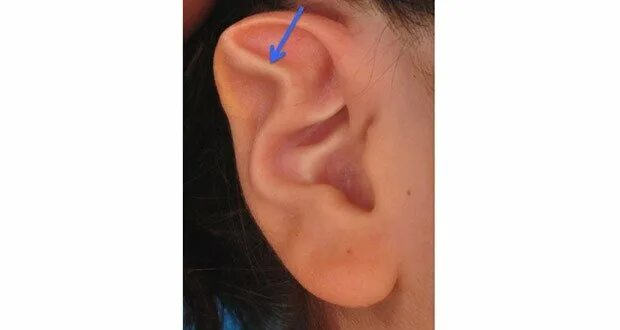 Бугорки дарвина на ушных раковинах. Дарвинов бугорок на ухе. Дарвинов бугорок на ухе. Дарвиновский бугорок уха. Дарвиновский бугорок уха.