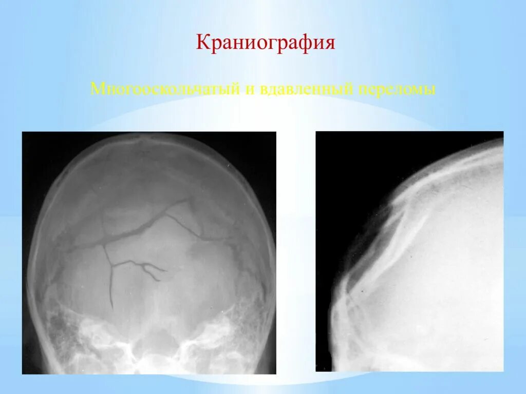 Многооскольчатый перелом черепа. ЧМТ повреждения костей черепа. Травмы черепа и головного мозга