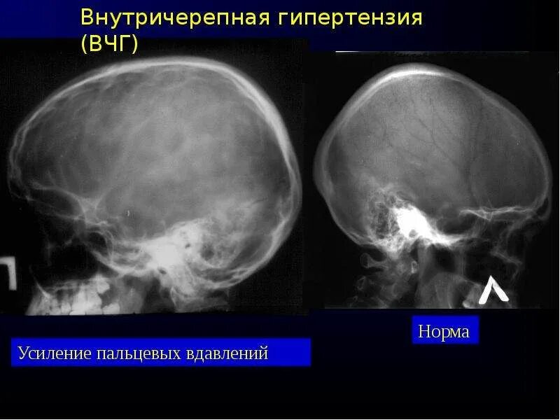 Пальцевые вдавления на черепе рентген. Внутричерепная гипертензия. Внутричерепное давление рентген. Рентгенограмма черепа при внутричерепной гипертензии.