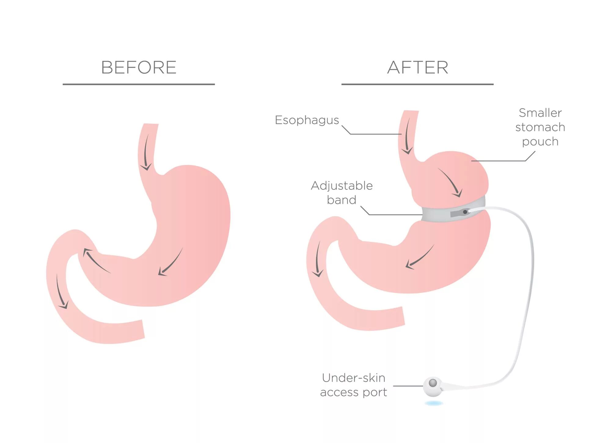 Бариатрическая хирургия это. Transit gastric Bypass. Бариатрическая хирургия.