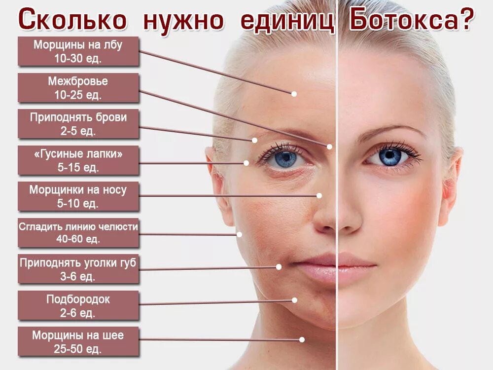 Ботокс какой эффект. Схема введения ботокса в межбровье. схема введения ботулотоксина. сколько единиц ботокса нужно. схема введения ботокса в лоб.
