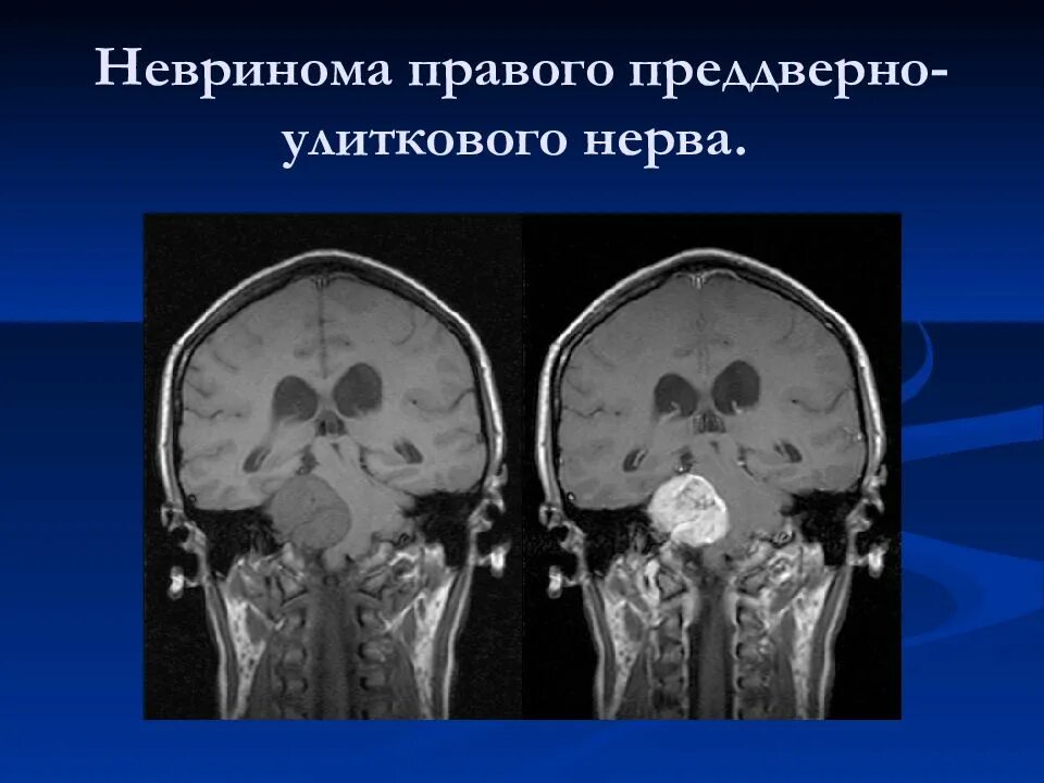 Невринома шваннома улиткового нерва. Шваннома слухового нерва макропрепарат. Невринома слухового нерва клиника. Опухоль шваннома головного мозга. Мрт лицевого нерва