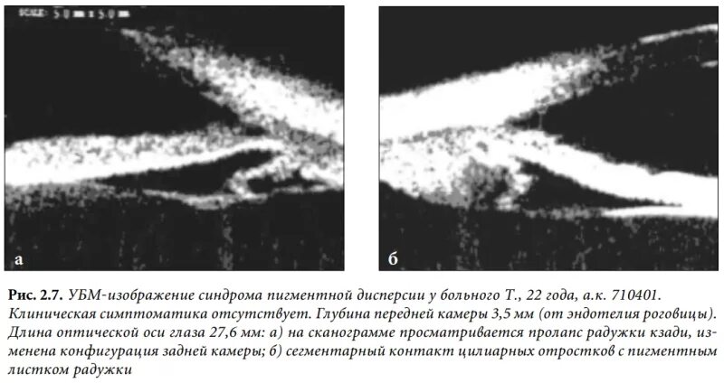Дисперсия синдром. Синдром пигментной дисперсии. синдром пигментной дисперсии глаза. синдром дисперсии пигмента глаза. убм при глаукоме.