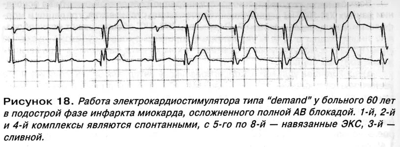 Сколько живут с кардиостимулятором. ЭКГ при экс с кардиостимулятором. Заключение ЭКГ при электрокардиостимуляции. Ритм кардиостимулятора. Ритм экс на ЭКГ.