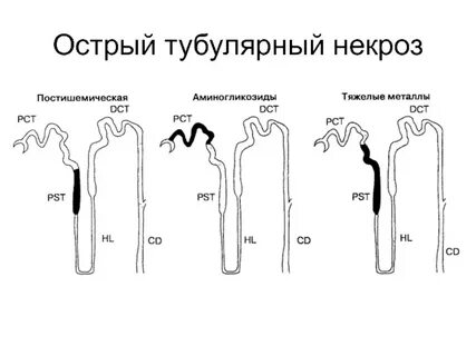 Острый тубулярный некроз почки