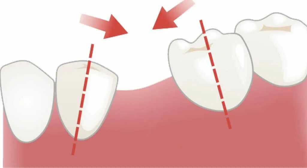 Смещение соседних зубов. Исправляем форму десен