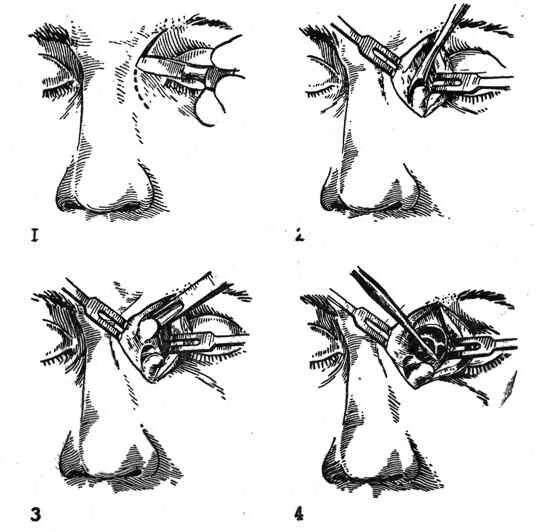 Фронтит воспаление лобной пазухи. Фронтотомия. Синусит фронтит этмоидит. Трепанопункция правой лобной пазухи. Фронтотомия.