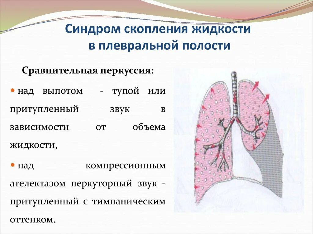 Вода в легких что делать. Жидкость в плевральной полости сравнительная перкуссия. Скопление жидкости в плевральной полости. Жидкость в плевральной полости скапливается. Скопления жидкости в плевральной полост.