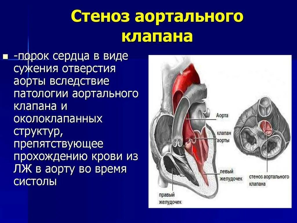 Стеноз аортального клапана сердца. Порок аортального клапана сердца. стеноз двустворчатого аортального клапана. стеноз и недостаточность аортального клапана. порок сердца двустворчатый аортальный клапан.