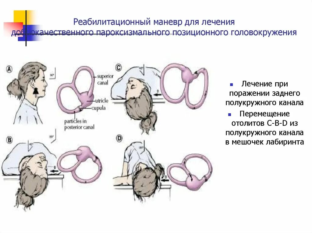 Дппг что это за болезнь. Позиционное головокружение. Пароксизмальное позиционное головокружение. Позиционные маневры при головокружении. ДППГ горизонтального полукружного канала.