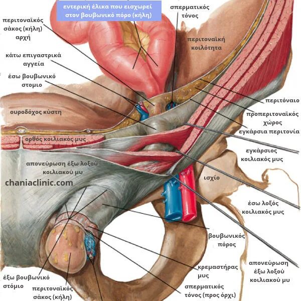 растяжение паховой связки. мышцы в паху у женщин. подвздошно - подчревный нерв, подвздошно - половой нерв. мышцы в области паха. анатомия бедренного канала у женщин.