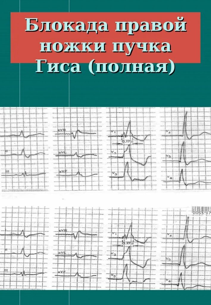 Гиса. Полная блокада правой ножки пучка гиса на экг. Полная блокада правой ножки п гиса. Блокада правой ножки пучка гиса на экг что это на экг. Экг полная блокада правой ножки п.