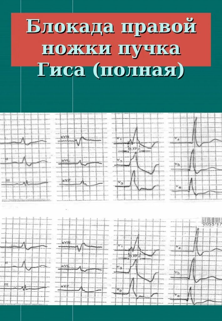 Гиса блокада пнпг. Полная блокада правой ножки пучка Гиса. Блокада ножки пучка Гиса. Ось при блокаде правой ножки пучка Гиса. Полная блокада ПНПГ.