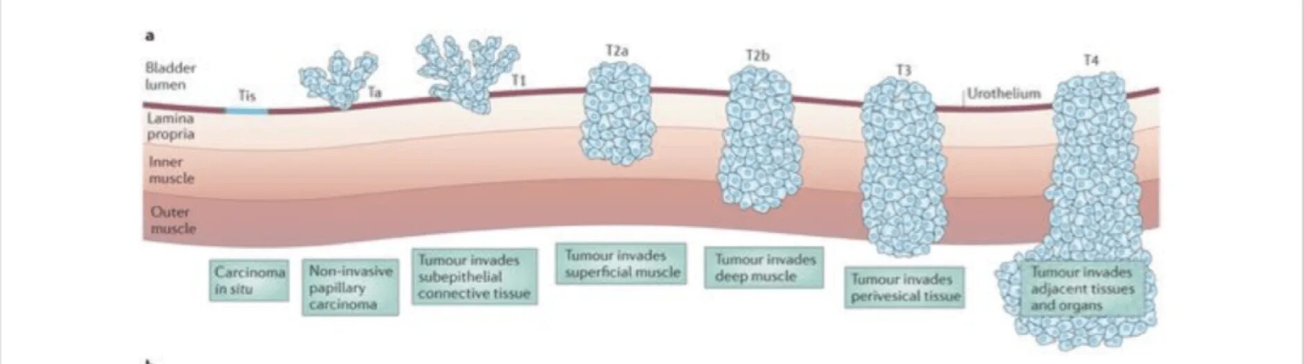 Опухоли мочевого пузыря патогенез. Опухоль мочевого пузыря в стадии т3:. Злокачественные новообразования мочевого пузыря классификация. Гистологическая классификация опухолей мочевого пузыря.