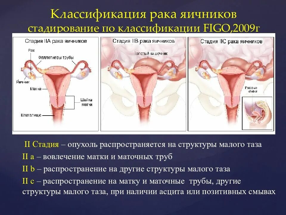 Классификация яичников. Стадии опухоли яичников. классификация опухолей и опухолевидных образований яичников. раковая опухоль яичника.