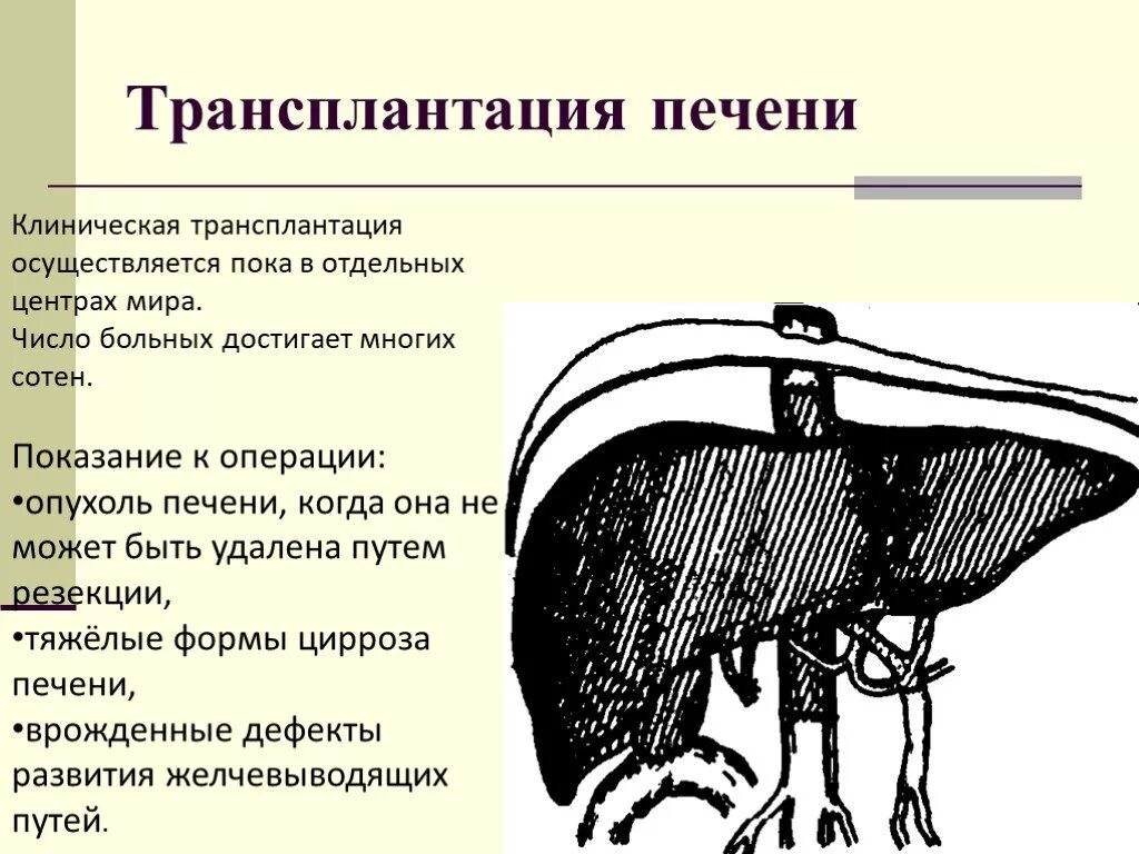 Трансплантация печени. Техника ортотопической трансплантации печени. Трансплантация печени презентация.