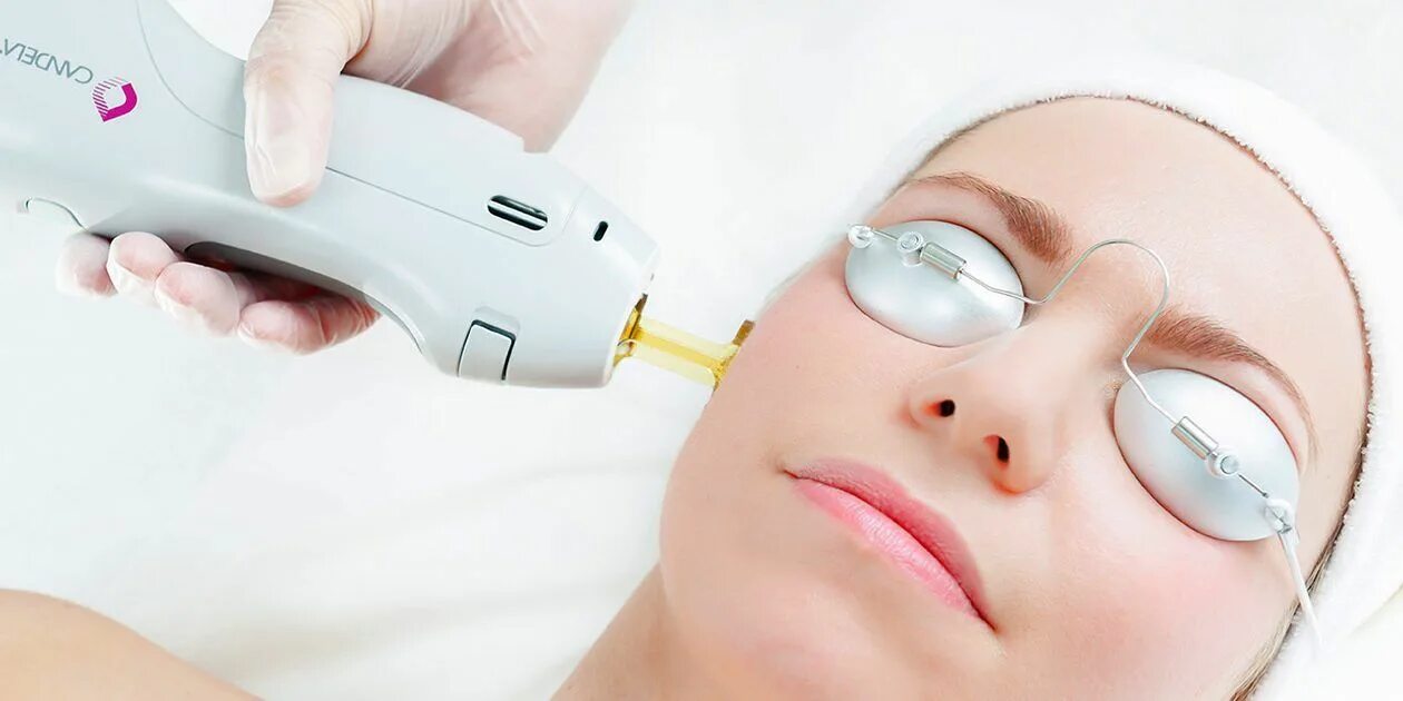 Омоложение сосудов. Vbeam candela лазер. фотоомоложение ipl m22. аппарат кандела. лазерное омоложение лица кандела.