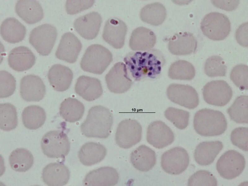 малярия вивакс. Plasmodium vivax возбудитель. плазмодий вивакс. Plasmodium вивакс. малярийный плазмодий мазок толстой крови.