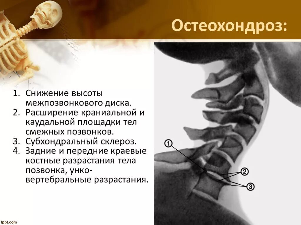 Склероз замыкательных пластинок позвоночника. Склерозированы замыкательные пластины позвоночника. Снижение высоты межпозвоночного диска. Снижение высоты тела позвонка. Снижена высота межпозвоночных дисков что это.