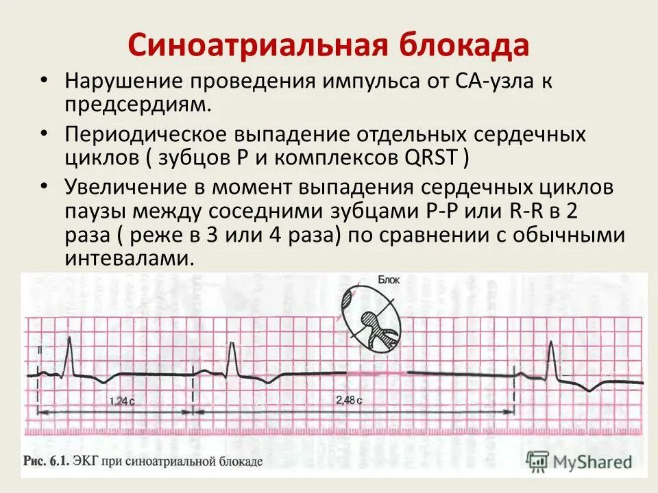 Блокада узла. ЭКГ при синоатриальной блокаде 3 степени. Синоатриальная блокада Мобитц 2. Синоатриальная блокада 2 на ЭКГ. Синоатриальная блокада Мобитц 1 ЭКГ.