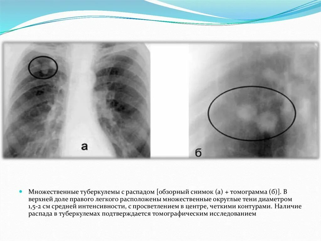 Туберкулема фтизиатрия. Туберкулома на кт. Туберкулема рентген описание. Солитарная туберкулема. Тени в верхней доле легкого