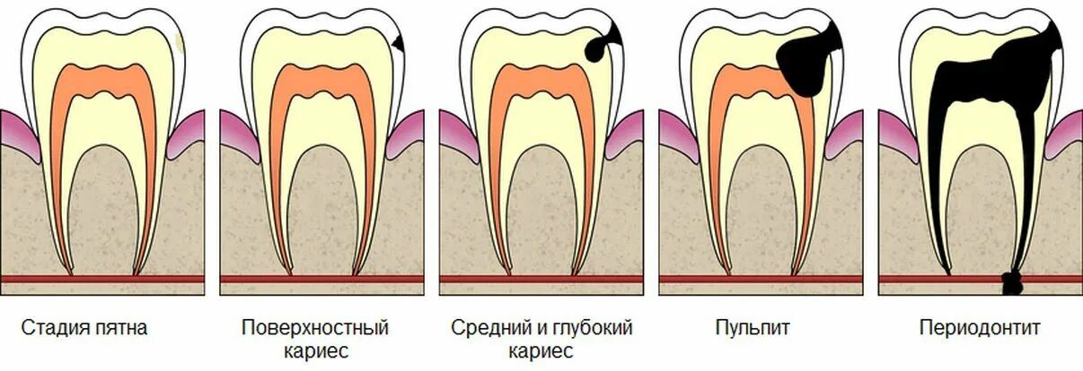 Периодонтит корня зуба - лечение в Брянске