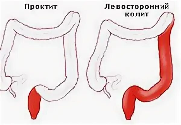 Колит симптомы у взрослых мужчин. Язвенный проктосигмоидит. Язвенный колит проктосигмоидит. Хронический катаральный колит. Язвенный колит кишечника левосторонний.