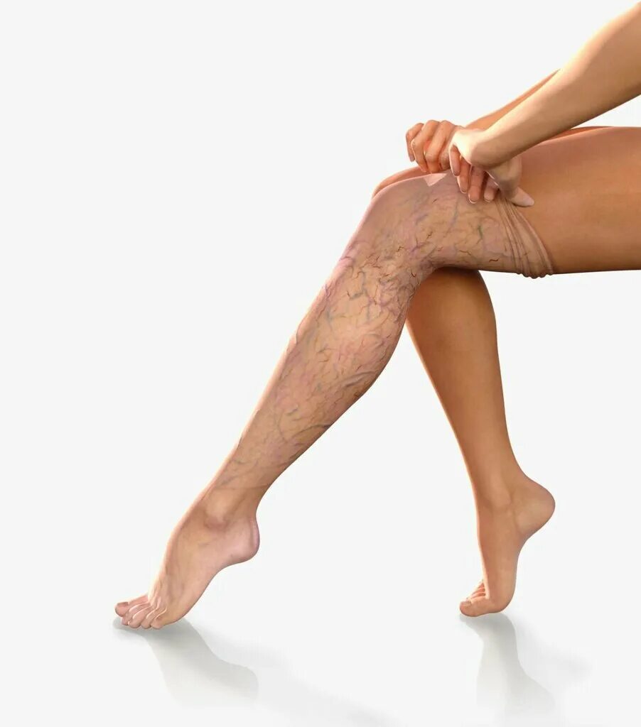 Народное средство от варикоза на ногах. Можно париться при варикозе ног. Народные средства от варикозного расширения вен. Варикозное расширение вен профилактика. Памятка варикозное расширение вен нижних конечностей.