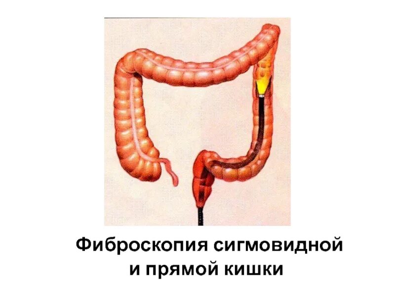 Просвет сигмовидной кишки. Кишечник сигмовидная кишка. сигмовидный отдел толстой кишки. строение сигмовидной кишки.